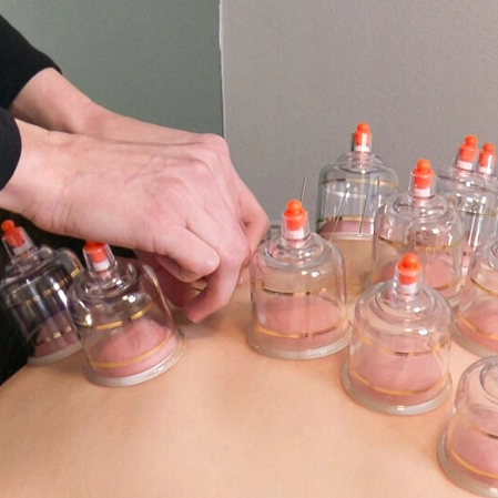 Acupuncture Springfield VA Cupping Treatment