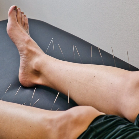Acupuncture Springfield VA Leg Therapy