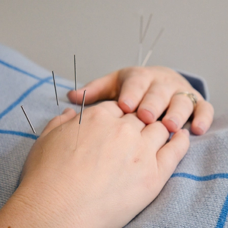 Chronic Pain Springfield VA Acupuncture