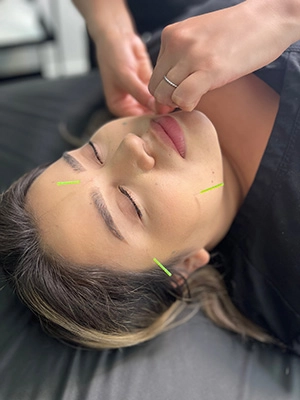 A patient receiving facial acupuncture