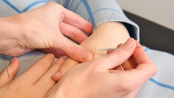 An acupuncturist putting needles in a patient's hands