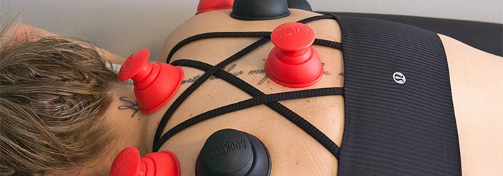 A patient with cupping pods applied to their back