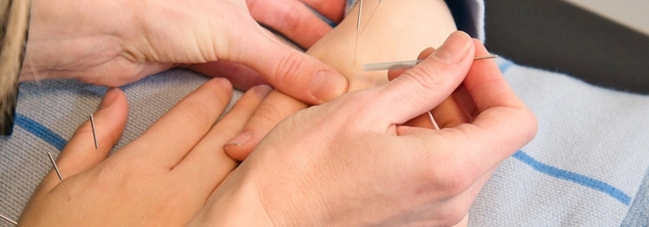 A patient receiving acupuncture treatment in their hands