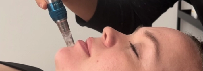 A practitioner using microneedling on a patient's face
